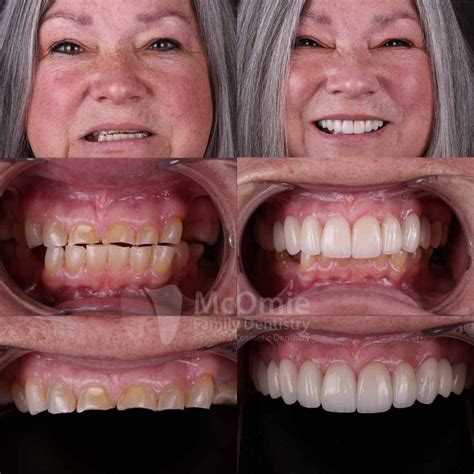 Full mouth reconstruction torrance